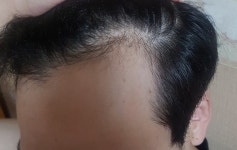 [남성탈모] 대전 모담의원 이식 M자 비절개 슬릿 1개월차 후기입니다 | 모발이식 후기, 리뷰, 비용은 대다모!