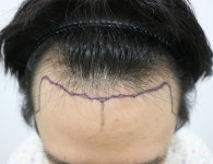 [모스트모발이식센터] 중이 제머리 못 깎고 머리심고 온 이야기 | 모발이식 후기, 리뷰, 비용은 대다모!