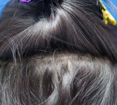 나세르 헤어라인했어요~ 5개월 경과^^ 나세르헤어라인했어요5개월경과