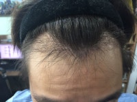 [男性型脱毛症] 毛髪移植4ヶ月なのに...うまく行ってないんですか··· | 植毛の体験談、レビュー、費用なら DAEDAMO！