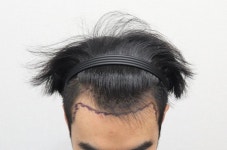 [모플러스성형외과] 2018년 12월 28일 M자 수술했습니다 | 모발이식 후기, 리뷰, 비용은 대다모!