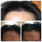 [뉴헤어모발성형외과의원] 뉴헤어 1,500모낭 4개월차입니다 (암흑기는 끝났겠지요?) | 모발이식 후기, 리뷰, 비용은 대다모!