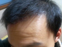 [남성탈모] 대구 모생외과의원 4천모 4개월 후기 및 프로스카 5개월차 후기 | 모발이식 후기, 리뷰, 비용은 대다모!