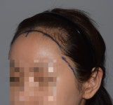 오랜만에 후기올려요 | 모발이식 후기,리뷰,비용은 대다모!