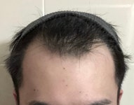 [모플러스성형외과] M자 비절개 2600모 5개월 | 모발이식 후기, 리뷰, 비용은 대다모!