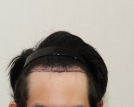 [뉴헤어모발성형외과의원] 뉴헤어 1300 +100모낭 7개월차 | 모발이식 후기, 리뷰, 비용은 대다모!