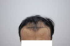 [Mobarun Clinic] ハンサンボで手術を受けてから3ヶ月が経過（費用は聞かないでください） | 植毛の体験談、レビュー、費用なら... 