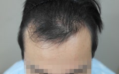 [남성탈모] 4000모 6개월 후기입니다. | 모발이식 후기, 리뷰, 비용은 대다모!