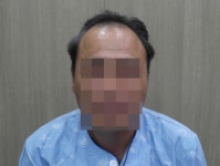[남성탈모] 부산에이지의원 4000모 6개월 후기입니다. | 모발이식 후기, 리뷰, 비용은 대다모!