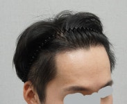 [모플러스성형외과] M자 2200모 1년 10개월 평가 | 모발이식 후기, 리뷰, 비용은 대다모!