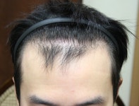 [남성탈모] 루트의원 Max 4000 절개 모발이식 | 모발이식 후기, 리뷰, 비용은 대다모!