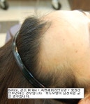 [모바른의원] 여성헤어라인 이식 고찰 부산 한상보모발이식센터 | 모발이식 후기, 리뷰, 비용은 대다모! [모바른의원] 여성헤어라인 이식 고찰... 