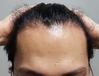 [남성탈모] 드림헤어라인 비절개 3천모 8개월 후기입니다. | 모발이식 후기, 리뷰, 비용은 대다모!