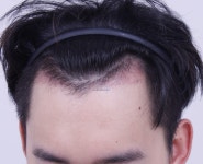 포헤어에서 수술한지 한달 지나고 리뷰 남겨봅니다 포헤어에서수술한지한달지나고리뷰남겨봅니다