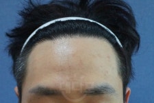 1000모낭 헤어라인 수술 10개월 후 후기 1000모낭헤어라인수술10개월후후기