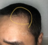 1400모낭 180일경과 1400모낭180일경과