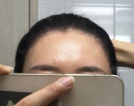 [헤어라인] [모두모의원 대구] 모발이식 1년 1개월 경과 | 모발이식 후기, 리뷰, 비용은 대다모!