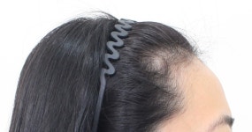 [모프로의원] 헤어라인 비절개 2700모, 1년 후기!! | 모발이식 후기, 리뷰, 비용은 대다모!