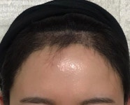 [헤어라인/NHI뉴헤어] 뉴헤어 3개월 경과 후기입니다. | 모발이식 후기, 리뷰, 비용은 대다모!