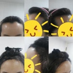 [헤어라인/NHI뉴헤어] 뉴헤어(5/31) 수술 후기요~^^ | 모발이식 후기, 리뷰, 비용은 대다모!