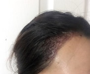 헤어라인교정후기 처음 남겨봅니다 [포헤어] 헤어라인교정후기 처음 남겨봅니다 | 모발이식 후기,리뷰,비용은 대다모!