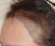 [헤어라인/압구정모비앙의원 광주점] 헤어라인 5일차 | 모발이식 후기, 리뷰, 비용은 대다모!