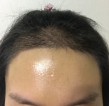 일주일 됐어요 [헤어라인/NHI뉴헤어] 일주일 됐어요 | 모발이식 후기, 리뷰, 비용은 대다모!