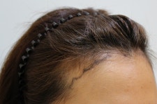 헤어라인 받고 3개월 지났어요~ (참닥터) [참닥터모발이식의원] 헤어라인 받고 3개월 지났어요~ (참닥터) | 모발이식 후기, 리뷰, 비용은 대다모!