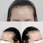 [헤어라인/NHI뉴헤어] 뉴헤어 1년차 만족후기입니다!(대략 4000모) | 모발이식 후기, 리뷰, 비용은 대다모!