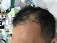 [두피문신] [연세미다인] 두피문신 3년후 치료 후기 | 모발이식 후기, 리뷰, 비용은 대다모!