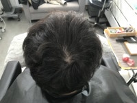 [두피문신] 연세미다인의원 두피문신 후기 | 모발이식 후기, 리뷰, 비용은 대다모!