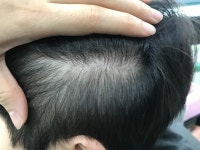 [두피문신] 연세미다인의원 측두부 두피문신 후기 | 모발이식 후기, 리뷰, 비용은 대다모!