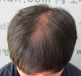 [모재성모발이식센터] 두피문신 받은지 45일 모재성 성형외과에서 받음 | 모발이식 후기, 리뷰, 비용은 대다모!