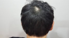 [두피문신] 강남 미켈란의원에서 비절개흉터 부분 두피문신했습니다. | 모발이식 후기, 리뷰, 비용은 대다모!