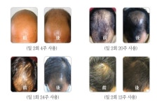 청뇌한의원 탈모클리닉 개설 소개