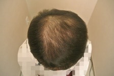 [두피문신] 두피문신흑채문신 후기연세모벨르 피부과의원 | 대한민국 1등 탈모 커뮤니티 대다모