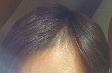 [Fuck탈모] 엠자 털리는거좀 봐주세요 | 대한민국 1등 탈모 커뮤니티 대다모