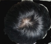 [Fuck Hair Loss] 정수리탈모 봐주세요 | Koreas No.1 Hair Loss Community, DAEDAMO