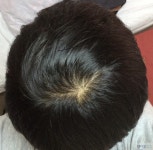 [Fuck Hair Loss] 2개월 간 정수리사진 | Koreas No.1 Hair Loss Community, DAEDAMO