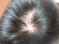 [Concerns & Counseling] 첫 진료 받고왔어요 | Koreas No.1 Hair Loss Community, DAEDAMO