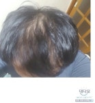 [나의치료법] 치료 198일차 전후 비교 나의치료법 치료 198일차  전후 비교