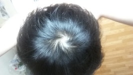 [Concerns & Counseling] 정수리탈모 치료 | Koreas No.1 Hair Loss Community, DAEDAMO