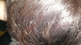 [Fuck Hair Loss] 모발색 한번 봐주셨으면 합니다 | Koreas No.1 Hair Loss Community, DAEDAMO