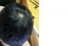 [Fuck탈모] 지금피부과 갔다오는길입니다. Fuck탈모 지금피부과 갔다오는길입니다