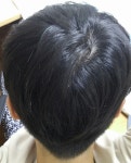 [Fuck탈모] 뒤통수쪽 봐주시겠어요 | 대한민국 1등 탈모 커뮤니티 대다모