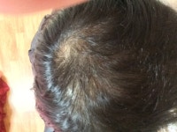 [Concerns & Counseling] 이정도 정수리 탈모프페로 치료가능할까요 | Koreas No.1 Hair Loss Community, DAEDAMO