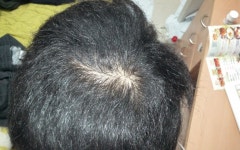 [Fuck Hair Loss] 20살 정수리탈모 맞나요 | Koreas No.1 Hair Loss Community, DAEDAMO