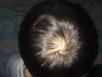 [General Chat] 정수리 탈모 | Koreas No.1 Hair Loss Community, DAEDAMO