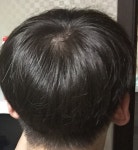 [고민상담] 여름철에 원래 머리에 힘이 없어지나요 | 대한민국 1등 탈모 커뮤니티 대다모