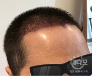 절개모발이식 4017모수 1일차 올립니다 (두드림 성형외과) 절개모발이식4017모수1일차올립니다두드림성형외과